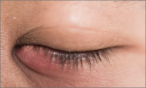 Meibom dysfunction
