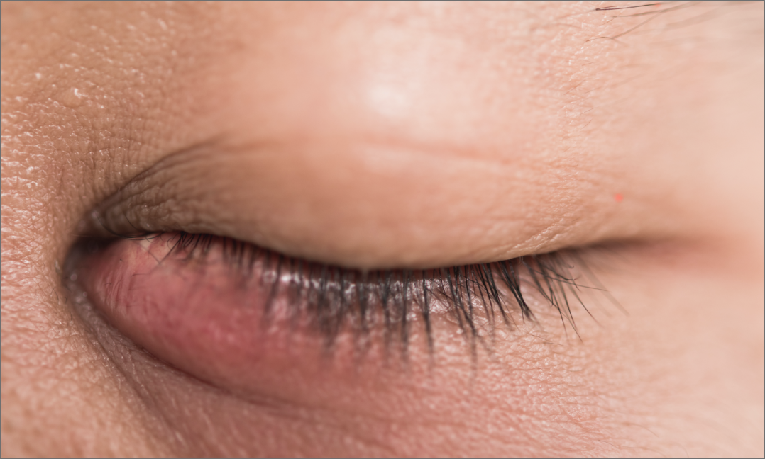 Meibom dysfunction